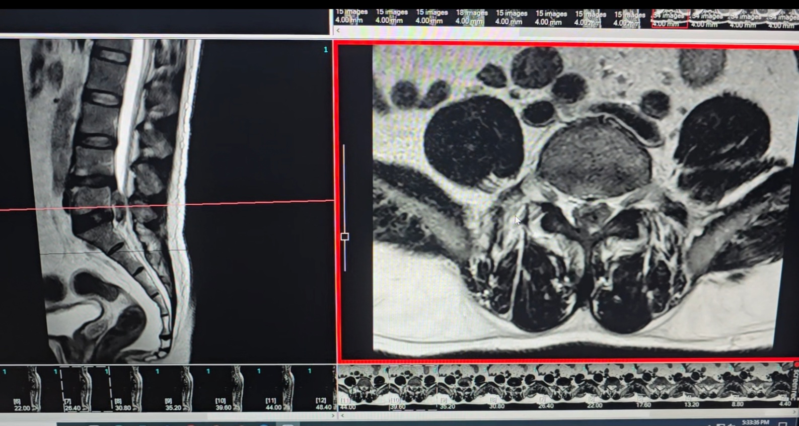 MRI Imaging - Spinal Diagnostic