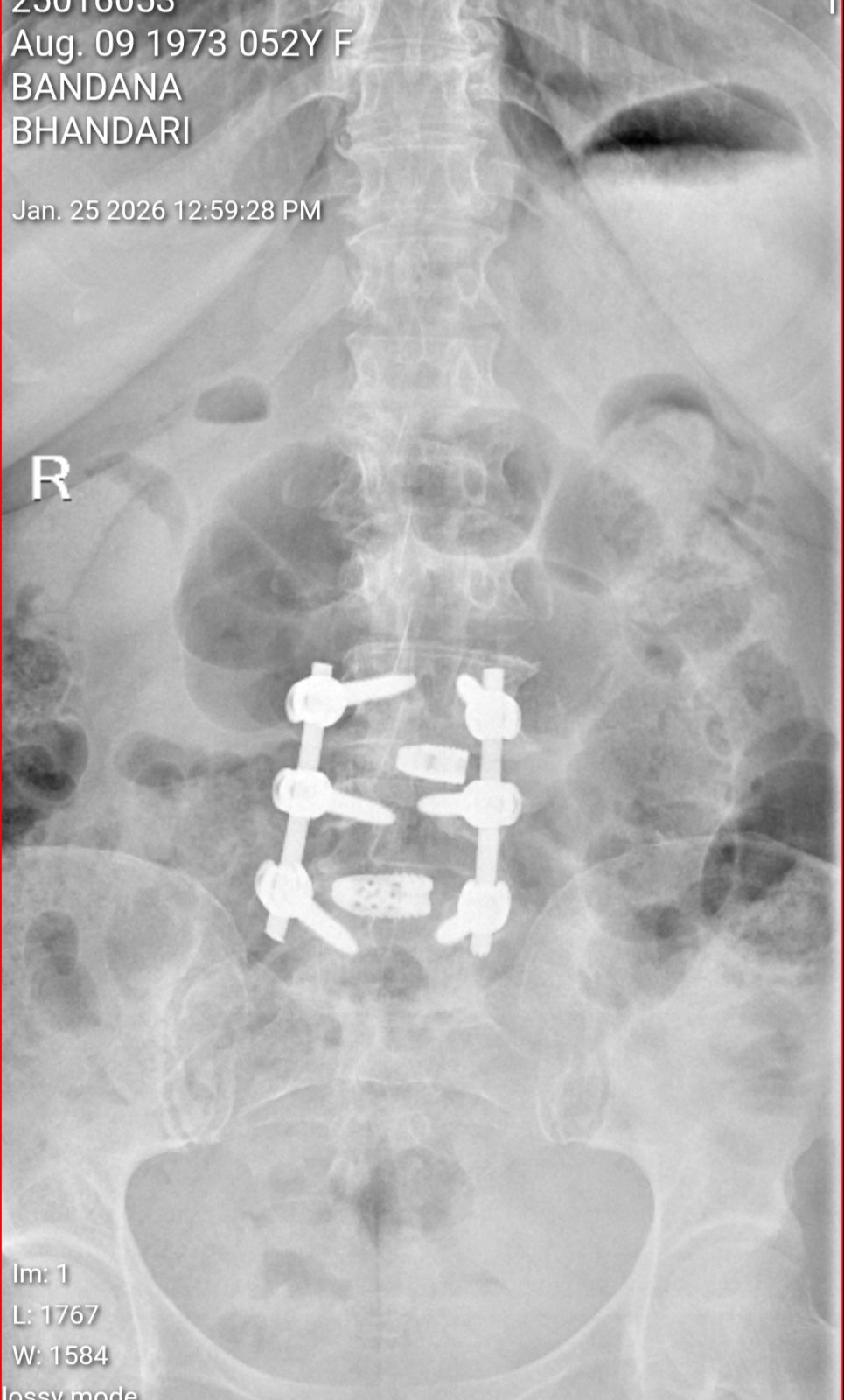 Spine Surgery Case - Bandana Bhandari